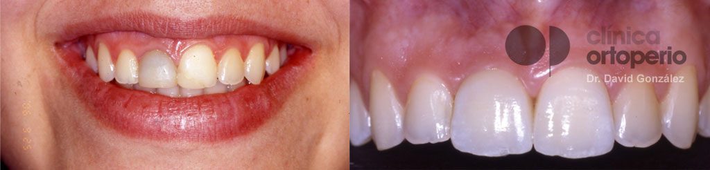Implante inmediato unitario (para reponer un solo diente) | Clínica Dental Ortoperio
