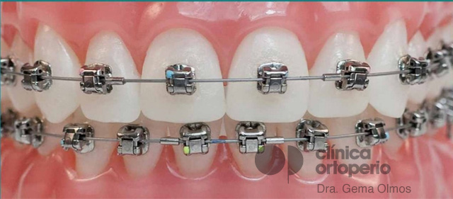 Brackets de autoligado: Brackets Damon | Clínica Dental Ortoperio