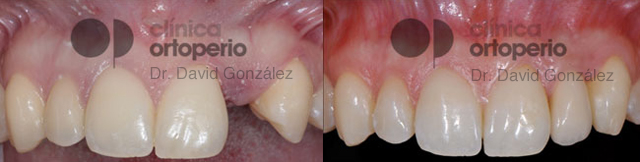Agenesia de incisivos laterales (cuando no salen los dientes permanentes)