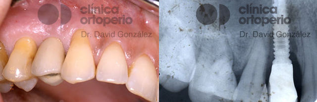 Tengo una infección en un implante. Periimplantitis | Clínica Dental Ortoperio
