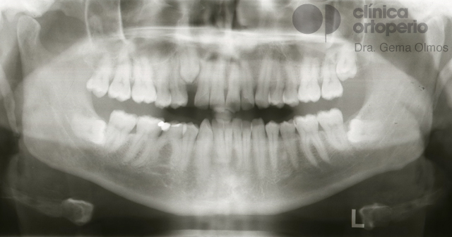 Caninos impactados|Clínica Dental Ortoperio