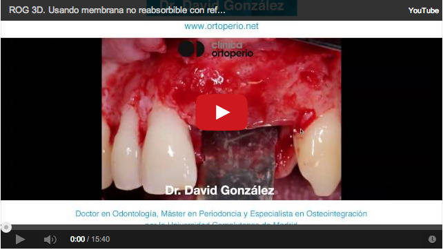 ROG 3D. Usando membrana no reabsorbible con refuerzo de titanio | Clínica Dental Ortoperio