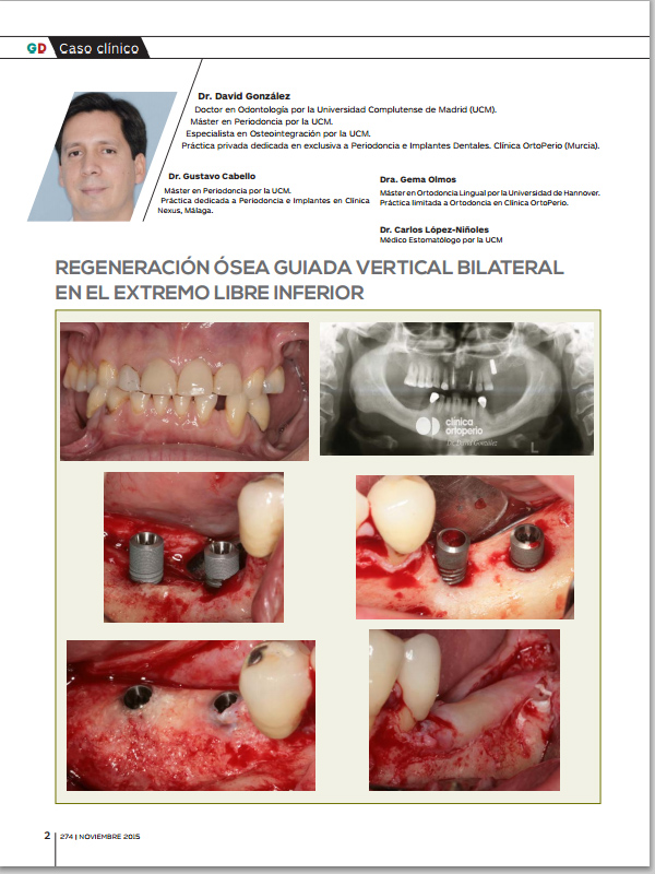 Nueva Publicación del Dr. González y cols. REGENERACIÓN ÓSEA GUIADA VERTICAL BILATERAL EN EL EXTREMO LIBRE INFERIOR|Clínica Dental Ortoperio