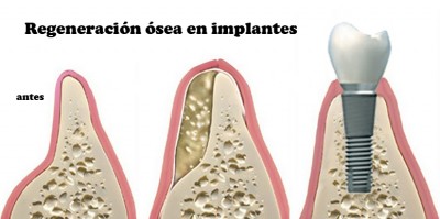 Me han dicho que no tengo hueso para colocarme implantes y que me harán un puente...|Clínica Dental Ortoperio