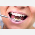 Recementado de brackets linguales | Clínica Dental Ortoperio