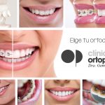 Tipo de ortodoncia ¿cuál es la mejor? | Clínica Dental Ortoperio