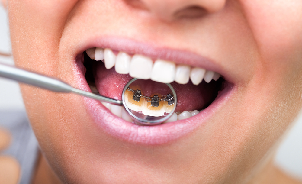 Brackets ¿cómo limpiarlos? | Clínica Dental Ortoperio