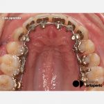 Curso de Ortodoncia Lingual impartido por la Dra Olmos, comienza la II Edición | Clínica Dental Ortoperio