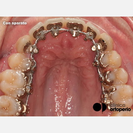 Ortodoncia lingual Murcia: Una alternativa de tratamiento 3
