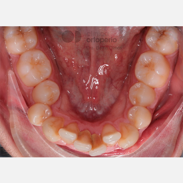 Apiñamiento dental severo. Tratamiento de ortodoncia sin extracciones. 1