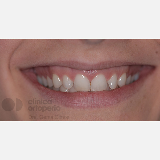 ¿Qué es una sonrisa gingival?|Clínica Dental Ortoperio