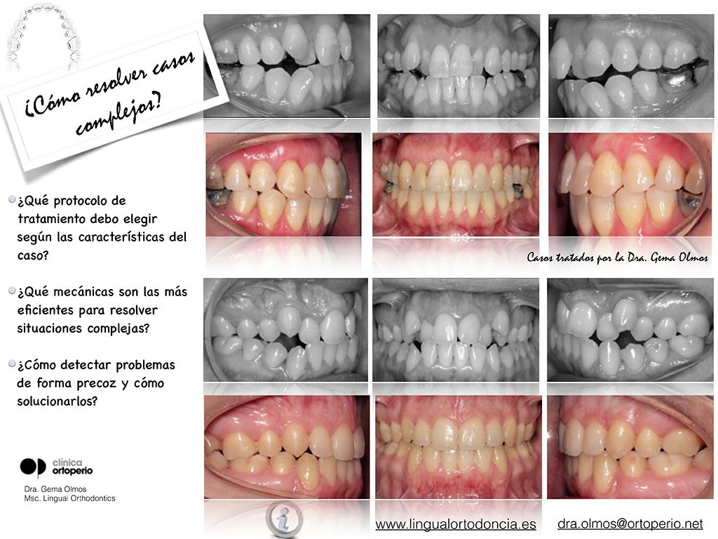 Curso de Ortodoncia Lingual Intensivo | Clínica Dental Ortoperio