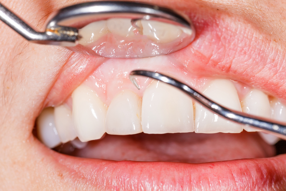 ¿Cómo eliminar el sarro de los dientes? 5
