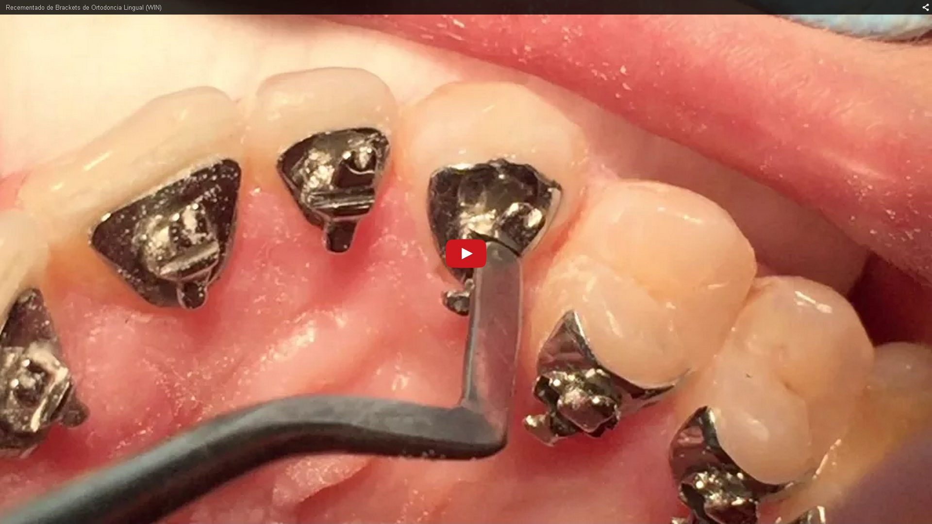 Recementado de brackets linguales|Clínica Dental Ortoperio