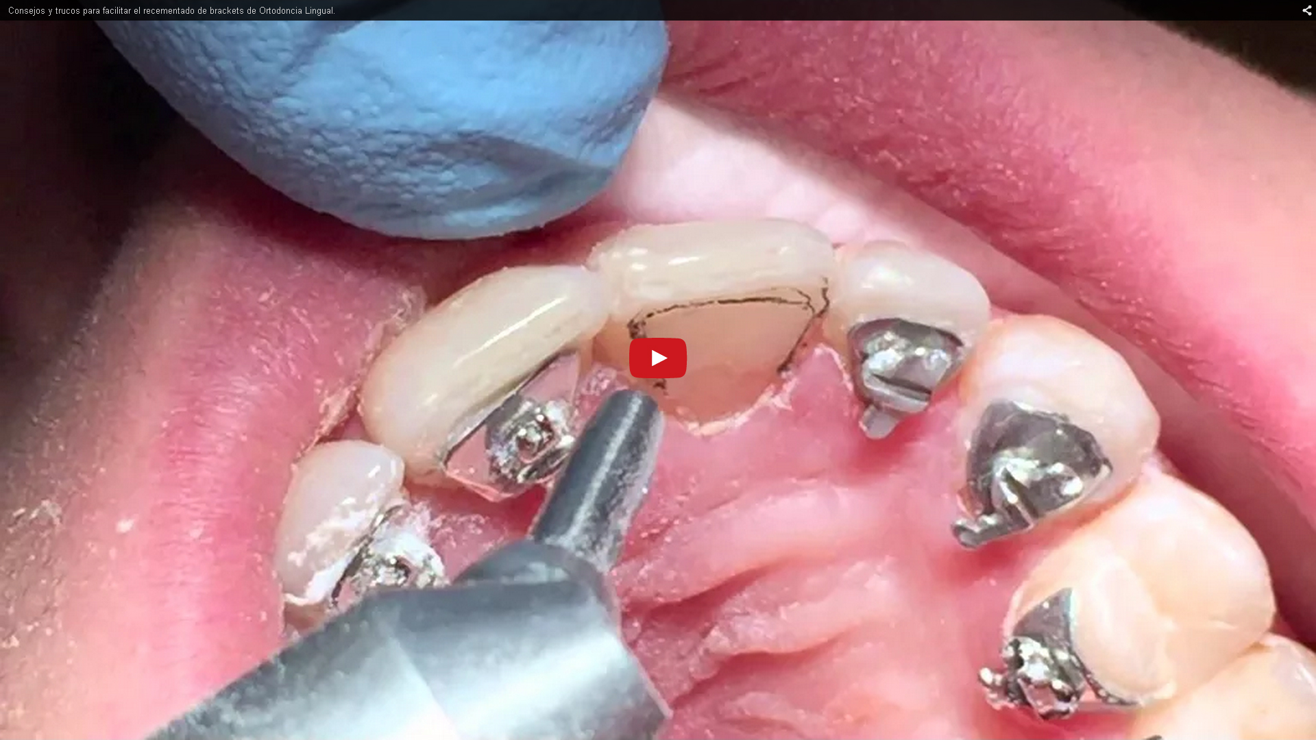 Trucos para el recementado de los brackets linguales|Clínica Dental Ortoperio
