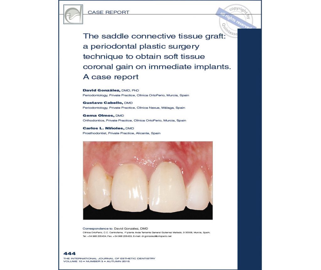 Implantes dentales: Nueva Publicación internacional del Dr. David González y cols. Clínica Ortoperio | Clínica Dental Ortoperio