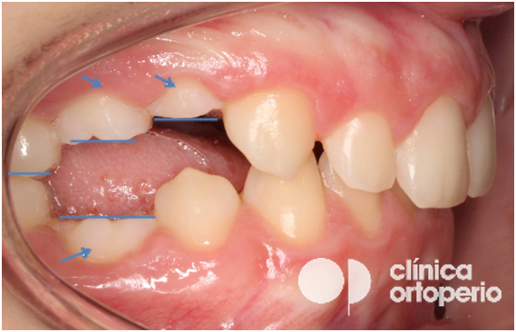 anquilosis dental