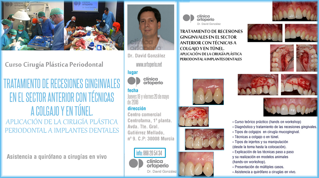 Curso de Cirugía Plástica Periodontal: Tratamiento de recesiones gingivales | Clínica Dental Ortoperio