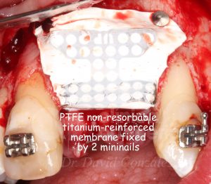 8 fijación membrana vestibular