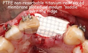 9 fijación membrana palatino