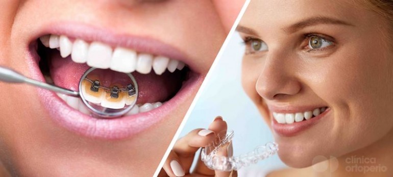 implantes dentales de calidad