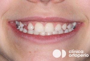 ortodoncia infantil en Murcia