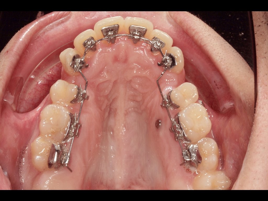 Ortodoncia Lingual Brackets