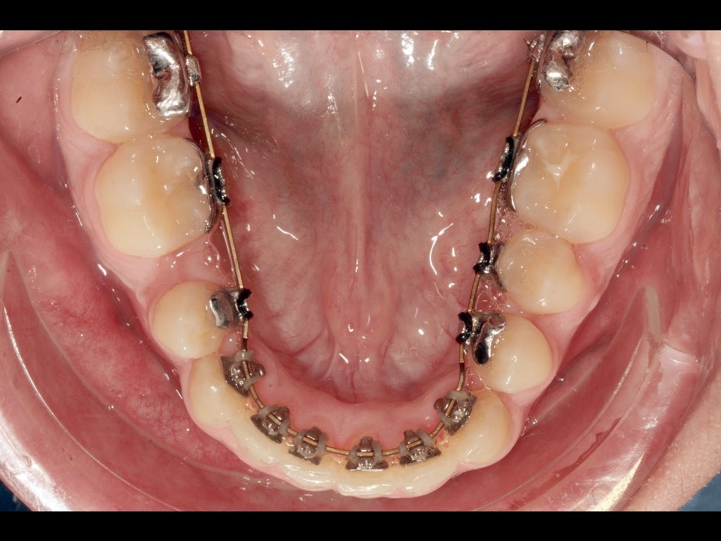Ortodoncia Lingual Brackets Ortoperio