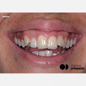 Caso de Ortodoncia Estética|Clínica Dental Ortoperio