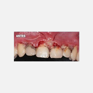 Acute necrotizing gingivitis|Clínica Dental Ortoperio