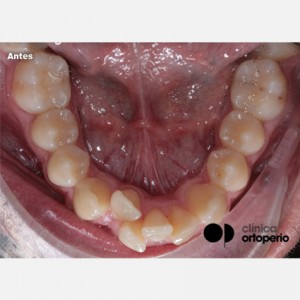 Invisalign orthodontics and connective tissue graft. Severe overcrowding|Clínica Dental Ortoperio