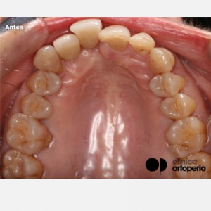Invisible orthodontics in cases where periodontitis has caused loss of bone tissue|Clínica Dental Ortoperio