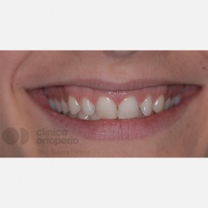 Lingual Orthodontics. Overbite excess, gingival smile, mild upper overcrowding|Clínica Dental Ortoperio