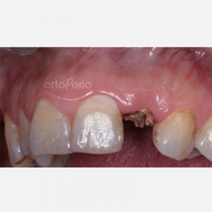 Removal of a fractured tooth and placement of an implant and an immediate crown|Clínica Dental Ortoperio