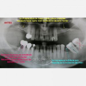 Sinus lift|Clínica Dental Ortoperio