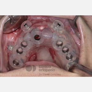 Implantes sin cirugía|Clínica Dental Ortoperio