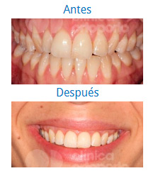 Casos Multidisciplinares|Clínica Dental Ortoperio