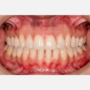 Lingual Orthodontics. Overcrowding|Clínica Dental Ortoperio