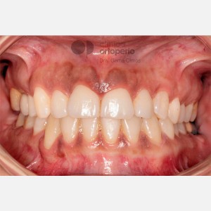 Lingual Orthodontics. Impacted canines. Multidisciplinary case: Orthodontic treatment and Implants|Clínica Dental Ortoperio