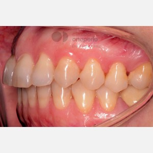 Ortodoncia Lingual. Caso Multidisciplinar: Ortodoncia e Implantes. Clase II/2. Sobremordida profunda|Clínica Dental Ortoperio