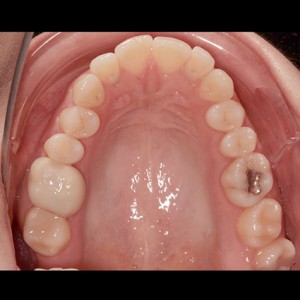 Ortodoncia Lingual. Tratamiento de una maloclusión compleja de clase III y mordida abierta en paciente adulto.|Clínica Dental Ortoperio