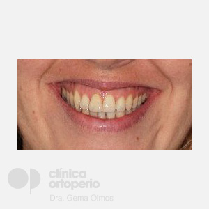 Lingual Orthodontics. Orthodontic re-treatment|Clínica Dental Ortoperio