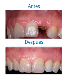 Implants|Clínica Dental Ortoperio