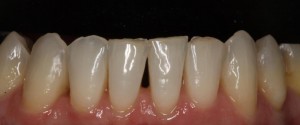 Closure of black triangles in lower incisors with composite veneers|Clínica Dental Ortoperio