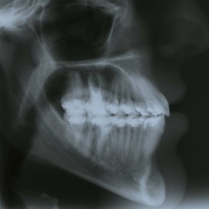 Ortodoncia Lingual. Tratamiento de una maloclusión compleja de clase III y mordida abierta en paciente adulto.|Clínica Dental Ortoperio