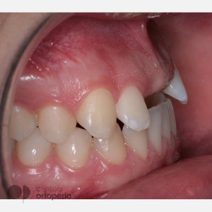 Ortodoncia Lingual + Injerto de hueso + Implantes dentales + Coronas de Zirconio-Porcelana|Clínica Dental Ortoperio