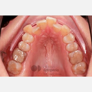 Lingual Orthodontics. Open bite, severe overcrowding. Gum graft|Clínica Dental Ortoperio