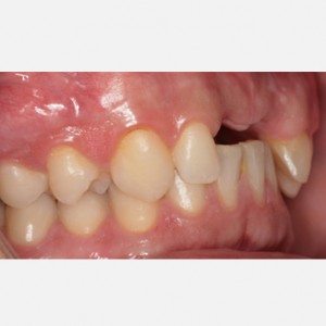 I do not have enough bone for implants|Clínica Dental Ortoperio