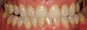 Blanqueamiento dental|Clínica Dental Ortoperio