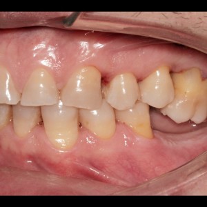 Molar intrusion with micro-implants, without orthodontic appliances|Clínica Dental Ortoperio